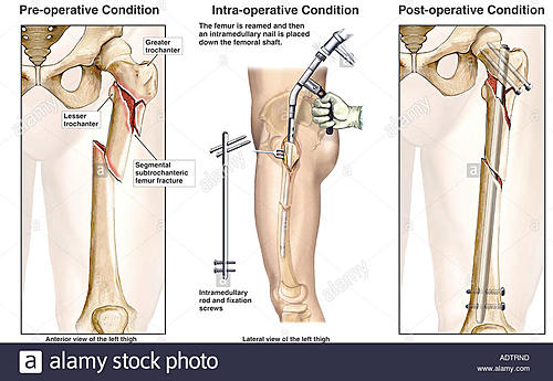 Recommendations for Armored Riding Shorts-left-subtrochanteric-femur-fracture-surgical