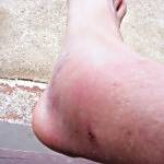 Oliver's foot after accident.